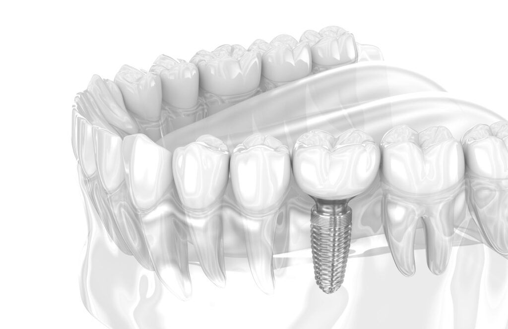 dental implantologist consultation