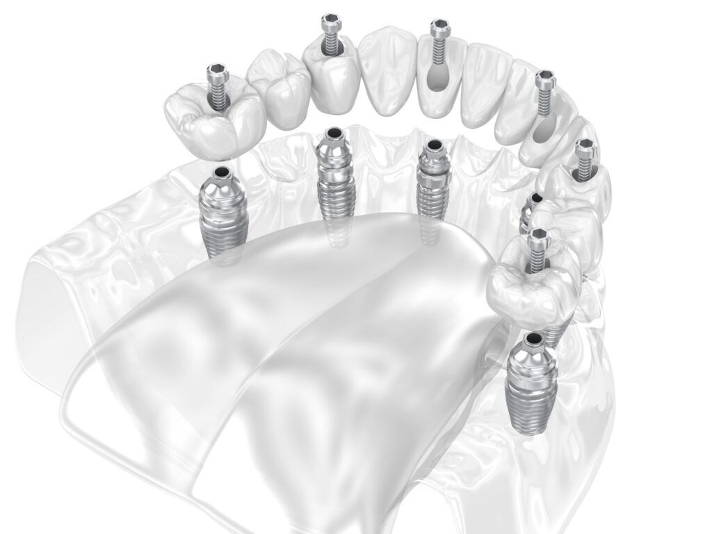 zobu plate uz implantiem
